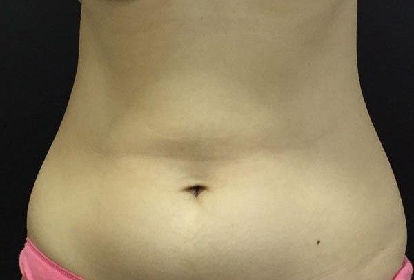 Body Coolsculpting After Treatment