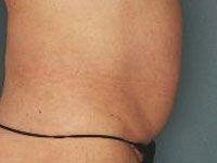 Body UltraShape After Treatment