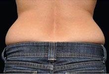 Body Coolsculpting Before Treatment