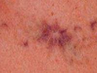 Laser Tattoo Removal Treatment