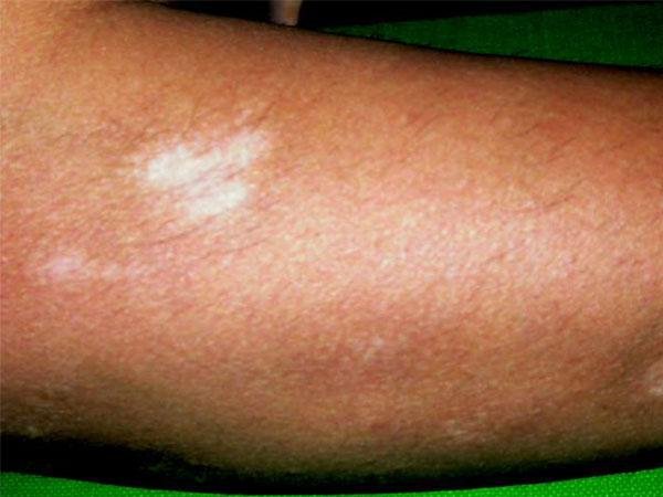 Before VTRAC Excimer Laser Treatment