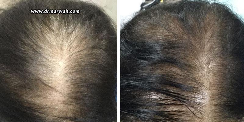 PRP-Treatment-for-Hair-Loss