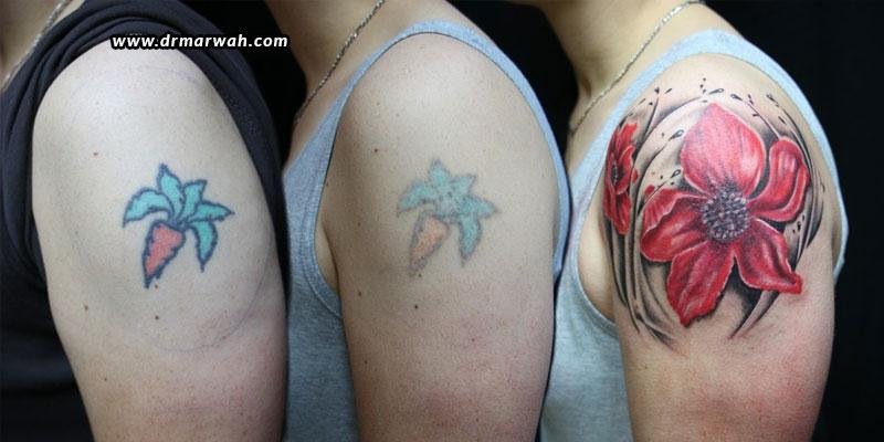 Tattoo-Removal-All-You-Need-To-Know