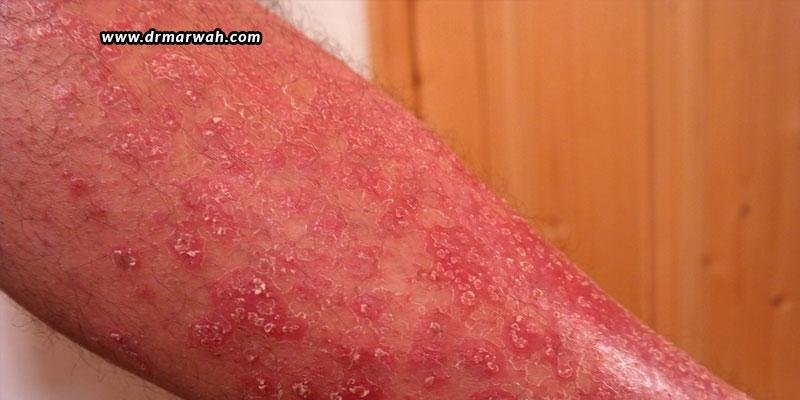 Psoriasis-Symptoms,-Causes-&-Treatments