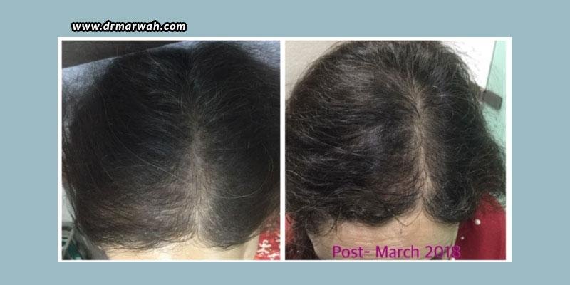 PRP-For-Hair-Loss-Before-And-After