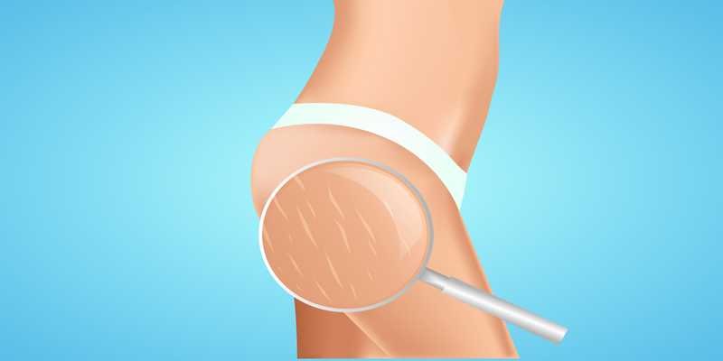 Stretch Marks Treatment